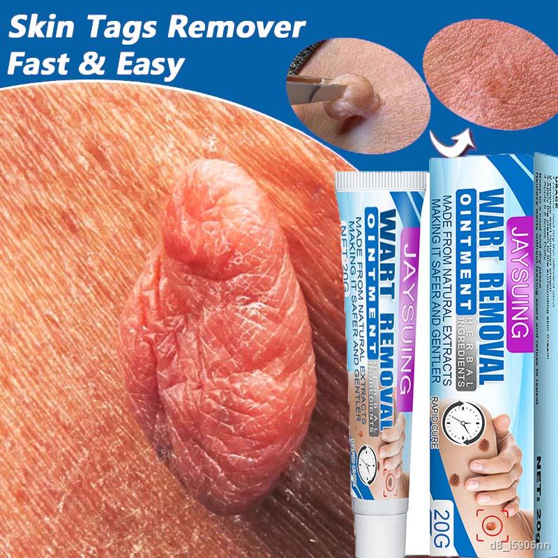 wart-removal-cream-skin-tags-treatment-safe-painless-herbal-antibacterial-ointment-foot-corn-removal-beauty-body-skin-ca