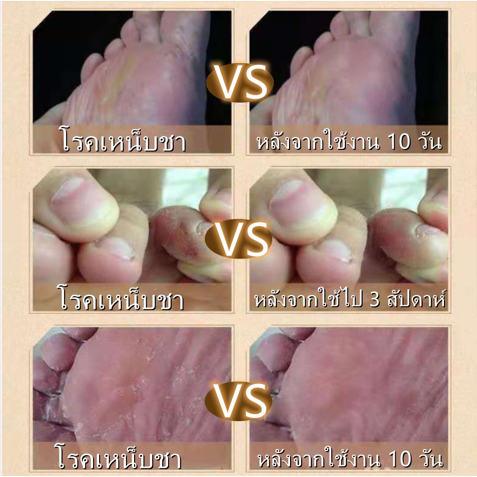 ของแท้100-ยาจีนแช่เท้า-สบู่สมุนไพรจีน-สบู่ต้านเชื้อรา-กลิ่นเท้าเหม็น-เท้าคัน-เกลื้อนมือและเท้า-เหงื่อเท้า-ส่งจากกรุงเท