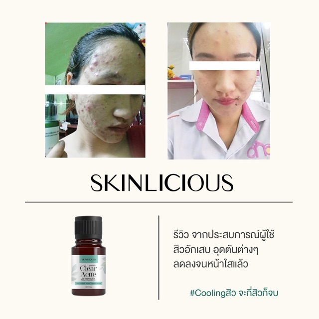 เซรั่มแต้มสิว-ลดการอักเสบ-skinlicious