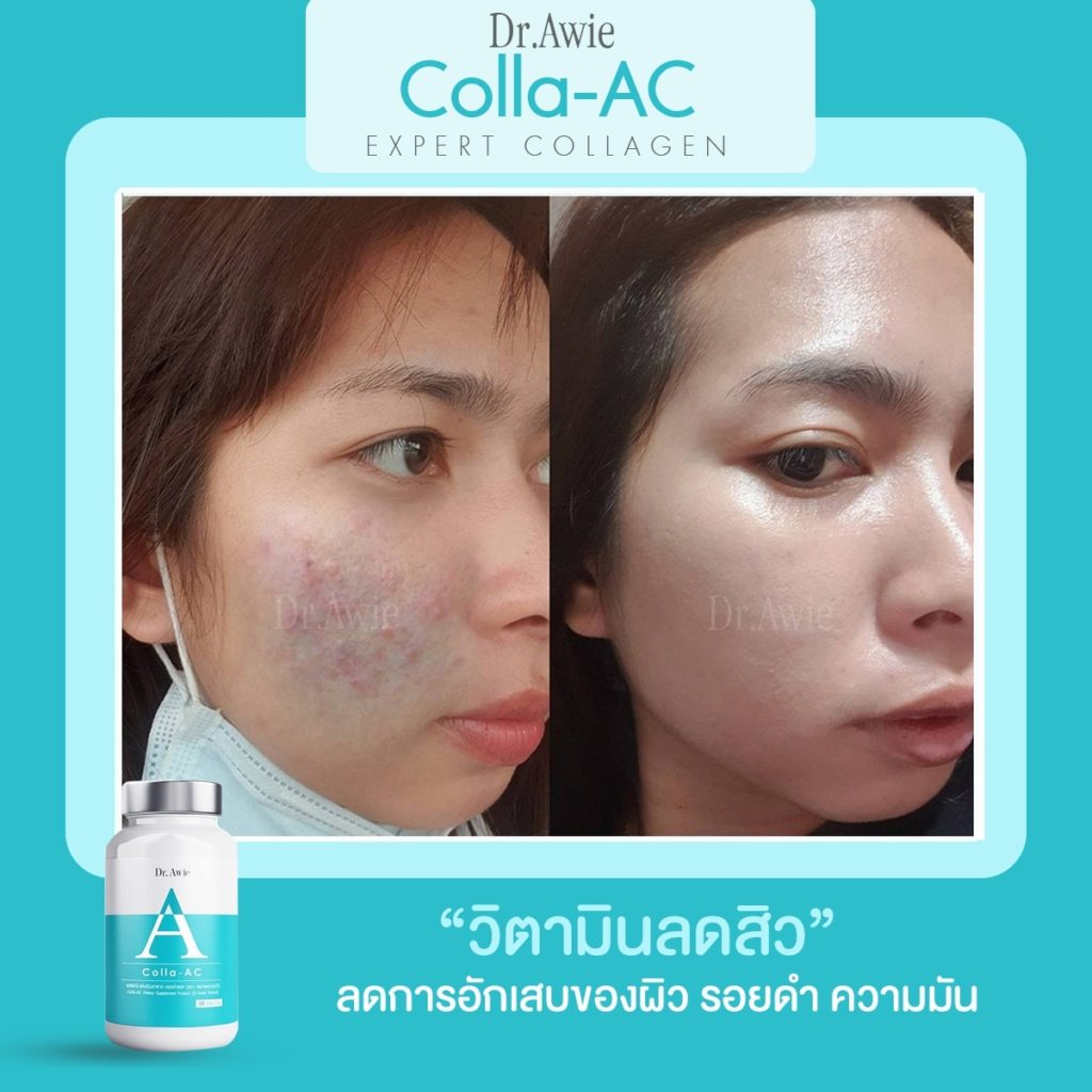 colla-ac-by-dr-awie-วิตามินลดสิว-หมอผึ้ง-ขายดีที่สุด-ลดการเกิดสิว-รอยดำ-รอยแดง-คุมมัน-30caps-กระปุก-1-กระปุก