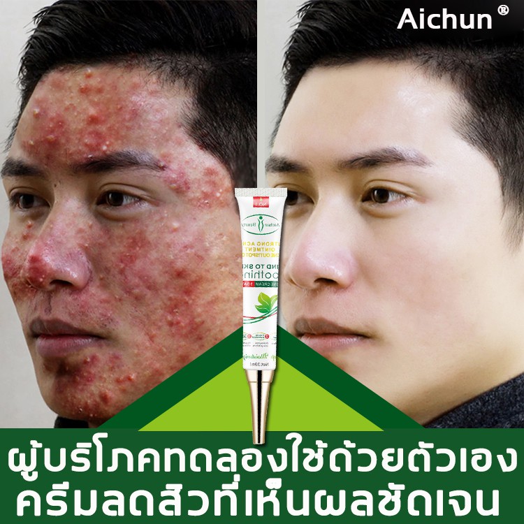 นำเข้า-aichunสมุนไพร-ครีมลดสิวลนสิวอย่างล้ำลึก-ครีมแต้มสิว-ครีมกำจัดสิว-เจลรักษาสิว-ครีมลบรอยดำสิว-เจลลดสิว-เจลแต้มสิว