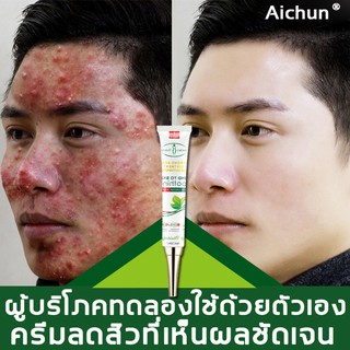 นำเข้า Aichunสมุนไพร ครีมลดสิวลนสิวอย่างล้ำลึก ครีมแต้มสิว ครีมกำจัดสิว เจลรักษาสิว ครีมลบรอยดำสิว เจลลดสิว เจลแต้มสิว