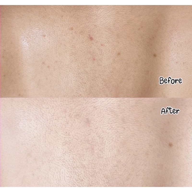 acne-ex-acne-body-mist-h-a-b-120-ml-สเปรย์รักษาสิว-ไร้สิว-จุดด่างดำ-ให้ผิวเนียนเรียบ