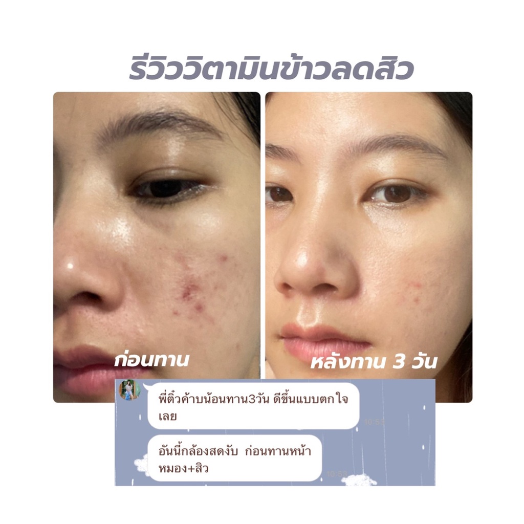 1-แถม-1-แถมฟรีวิตามินข้าว1กป-แพ็คเก็ตใหม่-วิตามินข้าวลดสิว-blahmbooh-ช่วยแก้ปัญหาสิวทุกประเภท-ลดสิว-ผิวหน้าใส