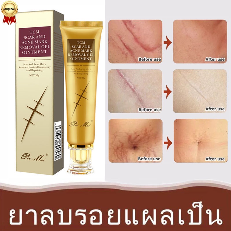 ปรับปรุงรอยแผลเป็น-ครีมลบแผลเป็น-ครีมลดรอยแผล-ยารักษาแผลเป็น-ยาทาแผลเป็นนูน-เจลลบรอยแผลเป็น-ครีมทาแผลเป็น-ครีมลบรอยแผลเป็น-น้ำร้อนลวก-รอยสิว-ครีมลดรอยสิว-แผลผ่าตัด-ครีมลดแผลเป็น-แผลเป็น-ครีมบำรุงหน้า-