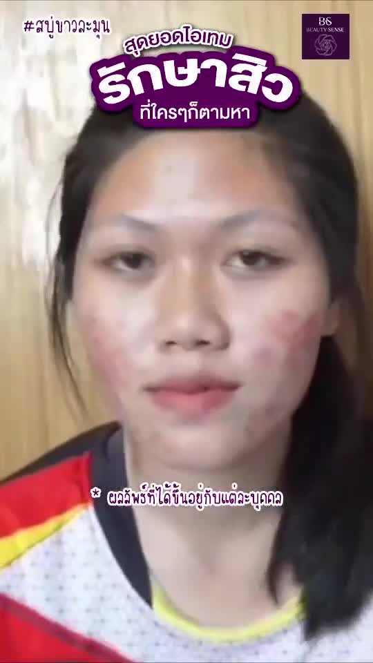beauty-sense-soap-สบู่บิวตี้เซ้นส์-สบู่ขาวละมุน-ปลอดภัย-ไร้สารสเตียรอยด์-ลดสิวหนอง-สิวอักเสบ-สบู่ลดสิว-ผิวติดสาร