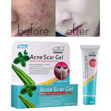acne-scar-gel-ให้ความชุ่มชื่นสดใสซ่อมแซม-ในรายการรวมด้วย-1-x-ว่านหางจระเข้แผลเป็นจากสิว