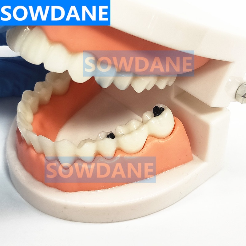 dental-tooth-model-teeth-model-dental-caries-model-for-patient-communication-dentist-study-model-with-decayed-tooth