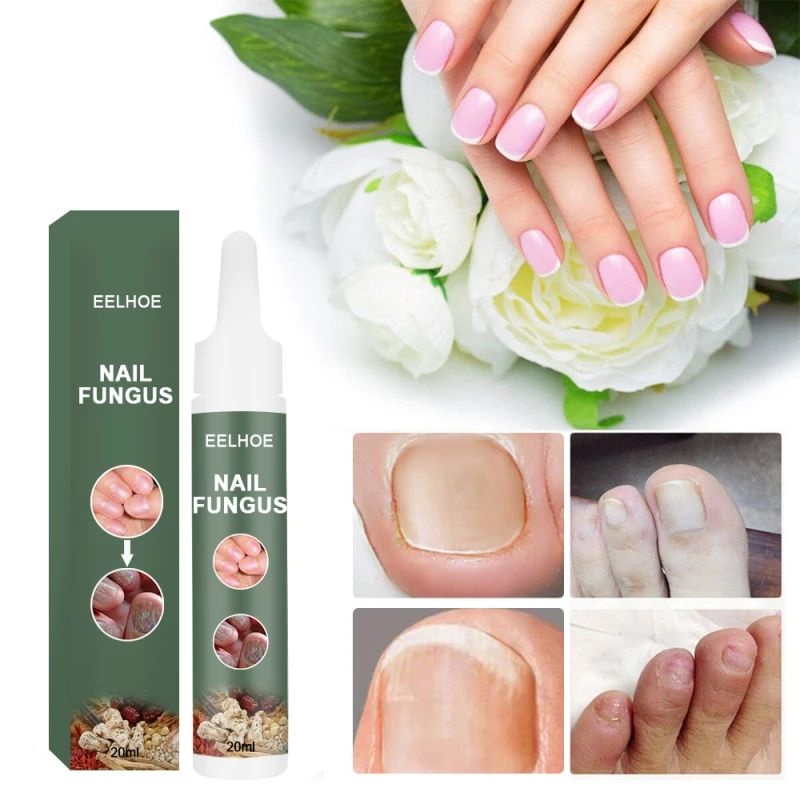 nail-fungus20ml-วิธีแก้ปัญหาการรักษาเชื้อราเล็บ-มือและเล็บเท้าที่แข็ง