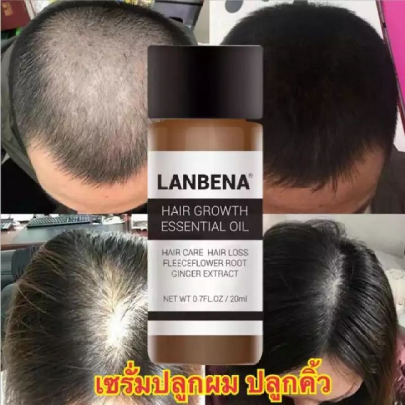 lanbena-น้ำยาปลูกผม-ป้องกันหัวล้าน-ป้องกันผมร่วง-รักษาผมร่วง-เร่งผมงอกใหม่-บำรุงผม-ฟื้นฟูผมแห้งเสีย-แก้ปัญหาผมร่วง-0380