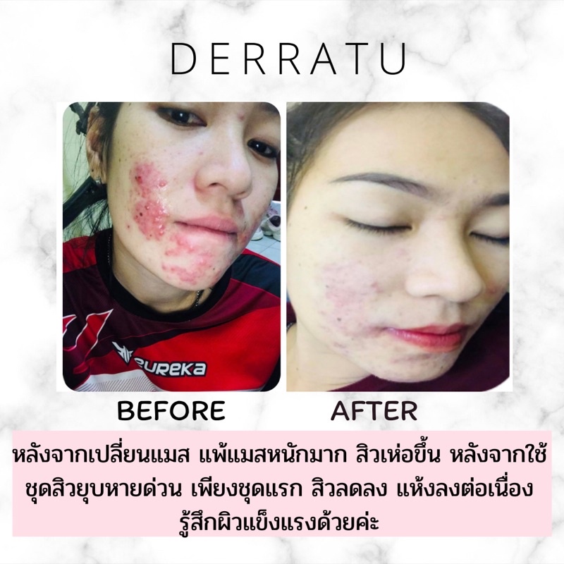 โฟมล้างหน้า-derratu-90g-2-ชิ้น-ลดสิวอุดตัน-ลดสิวหน้าใส-ลดมัน-ลดแผลสิว-หลุมสิวตื้น-รูขุมขนกระชับ