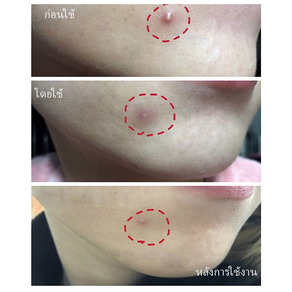 จัดส่งไว-breylee-แผ่นแปะสิว-มาส์กหน้า-สำหรับใช้ตอนกลางคืน-เจลแต้มสิว-acne-pimple-treatment