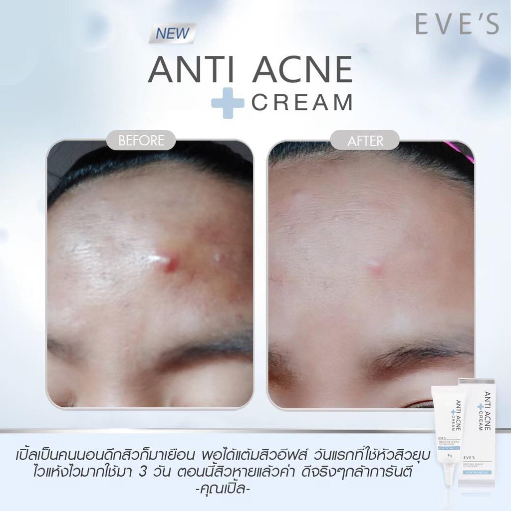 ครีมแต้มสิวอีฟส์-eves-anti-acne-cream-ขนาด-9-กรัม