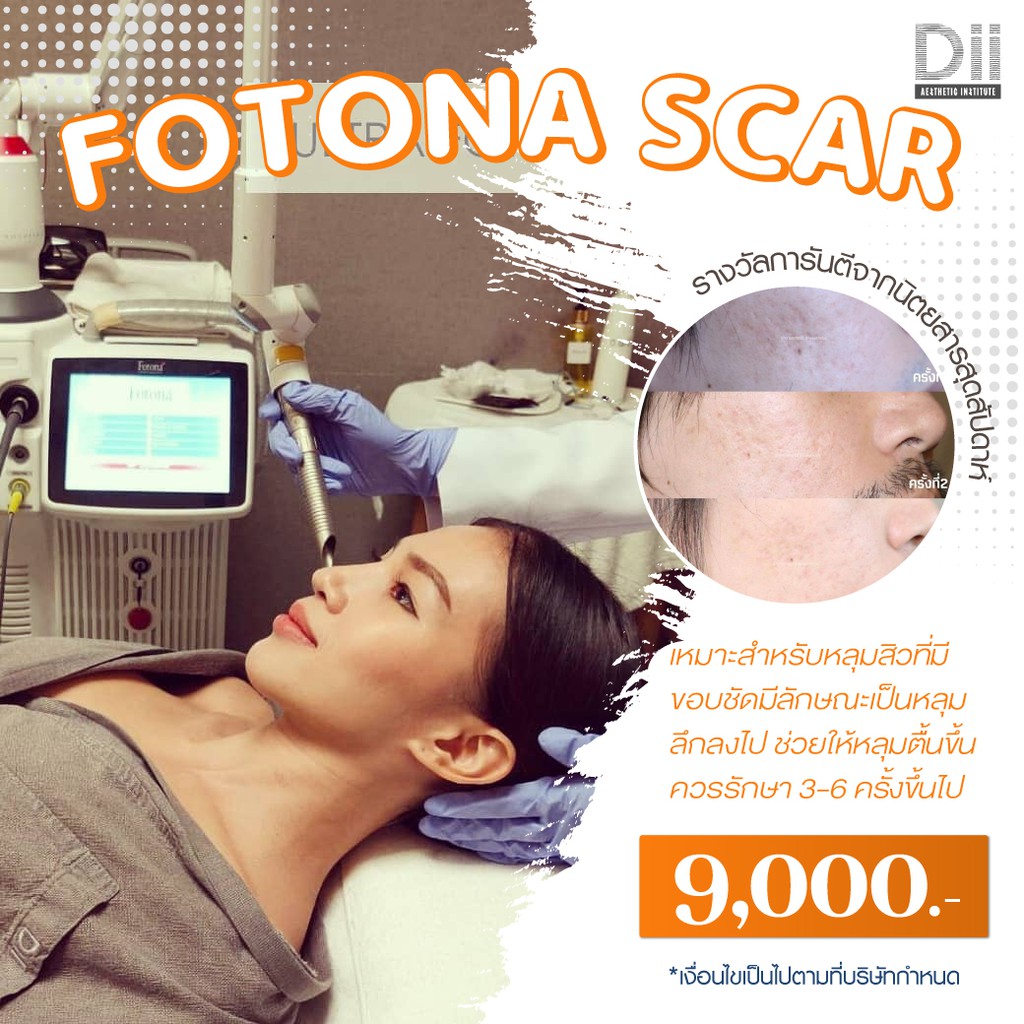 dii-aesthetic-fotona-acne-scar-เลเซอร์รักษาหลุมสิว