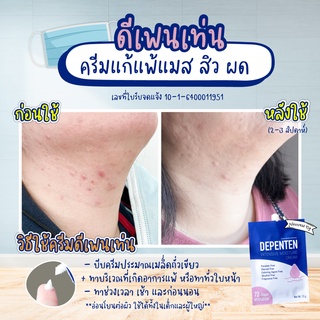 ครีมแก้แพ้แมส ลดผื่นแพ้ ลดสิวลดผด ไม่มีสเตียรอยด์/พาราเบน/น้ำหอม/สี อ่อนโยนต่อทุกผิว DEPENTEN INTENSIVE CREAM 15g