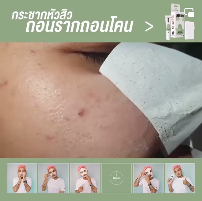 ครีมลอกสิวเสี้ยน-nakiz-lively-nose-ครีมลอกชาเขียว-หลุดยันราก-หมดปัญหาสิวเสี้ยน