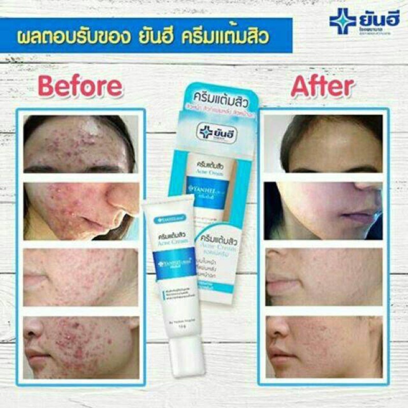 ของแท้-ยันฮี-แอคเน่-ครีม-ครีมแต้มสิว-yanhee-acne-cream-ขนาด-10-กรัม-สิวยุบ