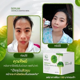 เซรั่มใบบัวบก เรื่องสิว