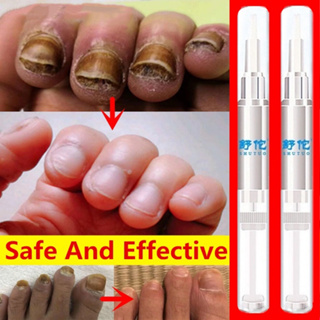 Onychomycosis Paronychia ปากกาสมุนไพร รักษาเชื้อราที่เล็บ เล็บนิ้วเท้า เล็บเท้า