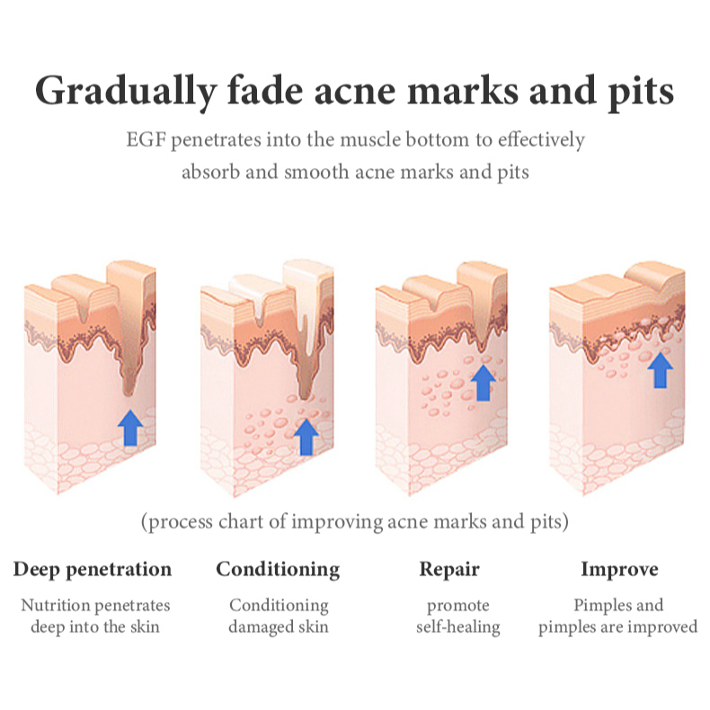 egf-ผงกําจัดสิว-ให้ความชุ่มชื้น-ปรับปรุงรูขุมขน-รูขุมขนกว้าง-และผิวเหลืองเข้ม