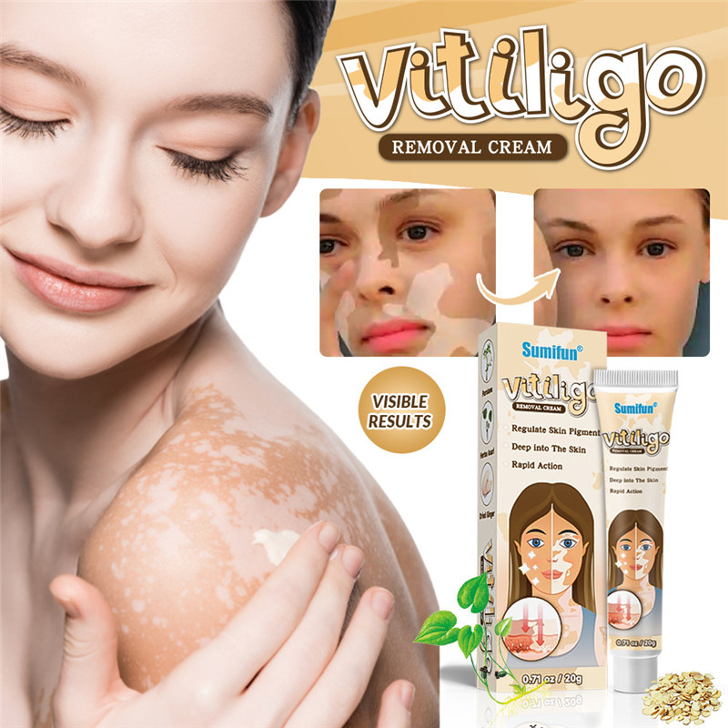 sumifun-vitiligo-ทรีทเม้นท์ครีม-vitiligo-ลบจุดด่างดํา-ubat-vitiligo-20-กรัม-vitiligo-repigment