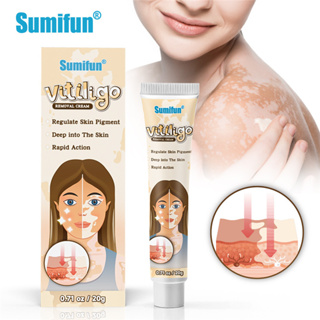 Sumifun vitiligo ทรีทเม้นท์ครีม vitiligo ลบจุดด่างดํา Ubat vitiligo 20 กรัม vitiligo repigment