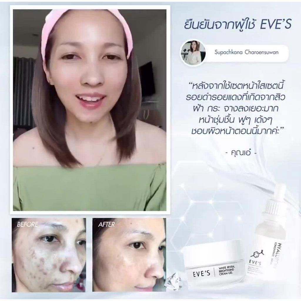 เซ็ทหน้าใส-เรียบเนียน-eves-cream-gel-eves-hyaluron-serum-กระชับรูขุมขน-ผิวเด้ง-ผิวอิ่มฟู-ลดรอยสิว-ลดฝ้ากระ-จุดด่างดำ