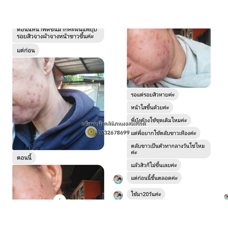 ส่งฟรี-ยารักษาสิว-ครีมรักษาสิว-ฮอร์โมนผิว-สิวอุดตัน-สิวอักเสบ-สิวหัวช้าง-สิวฮอร์โมน-สิวทุกชนิด