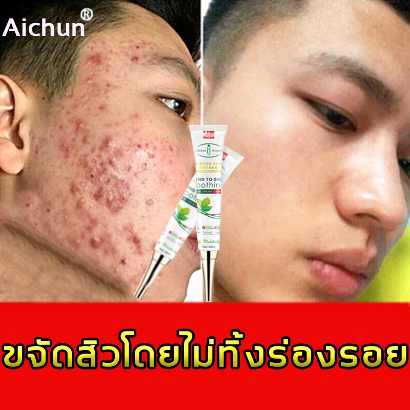 aichunครีมรักษาสิว30ml-ลบรอยสิวและรอยสิวได้อย่างมีประสิทธิภาพโดยไม่ทิ้งรอย-ครีมแต้มสิว-ผลิตภัณฑ์รักษาสิว-ครีมรักษาหลุมสิ