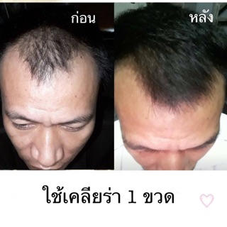 ภาพขนาดย่อของภาพหน้าปกสินค้าCleara *ลดเพิ่ม100 ทักแชท* เคลียร่า เซรั่ม สเปรย์ แชมพู : ปลูกผม ลดการหลุดร่วง ช่วยให้รากผมใหม่แข็งแรง ไม่หลุดร่วงง่าย จากร้าน atmyroom บน Shopee ภาพที่ 5