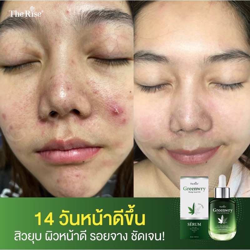 ส่งฟรี-มีของแถม-greenwry-serum-เซรั่มกัญชงลดสิวอักเสบ-ดีท็อกมาร์กหน้าแก้ฝ้ากระ-จุดด่างดำ-ริ้วรอยจางเห็นผลทันที