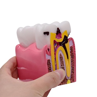 เครื่องมือทันตกรรมคุณภาพสูง 6 Times Caries Caries