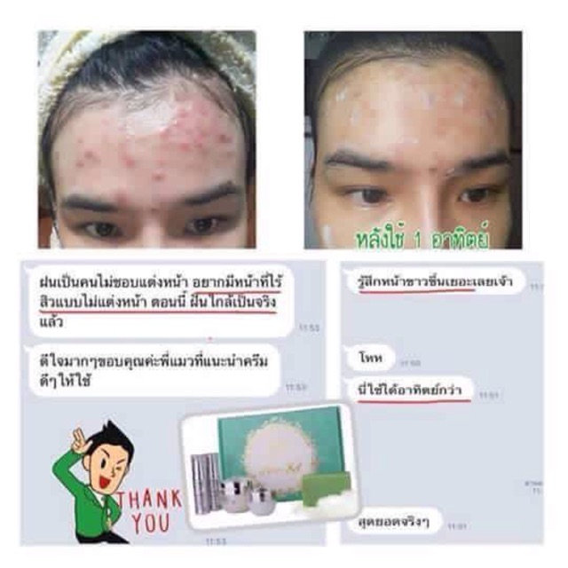 acne-set-บอกลาทุกปีญหาสิว