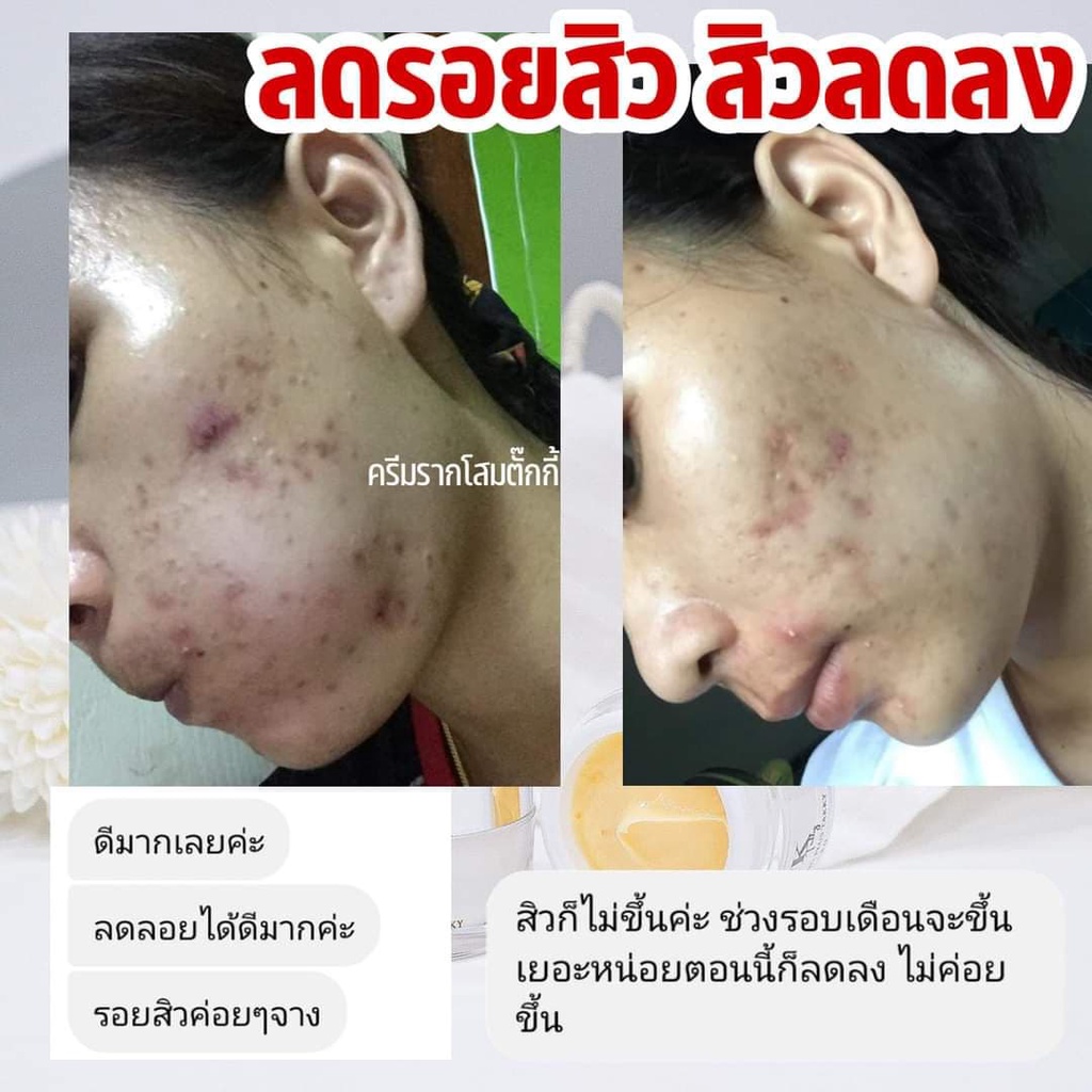 ครีมรากโสมtk-ครีมรากโสมหน้าใส-ครีมรากโสมลดสิวอุดตัน-สลายฝ้ากระ-ลดรอยสิว