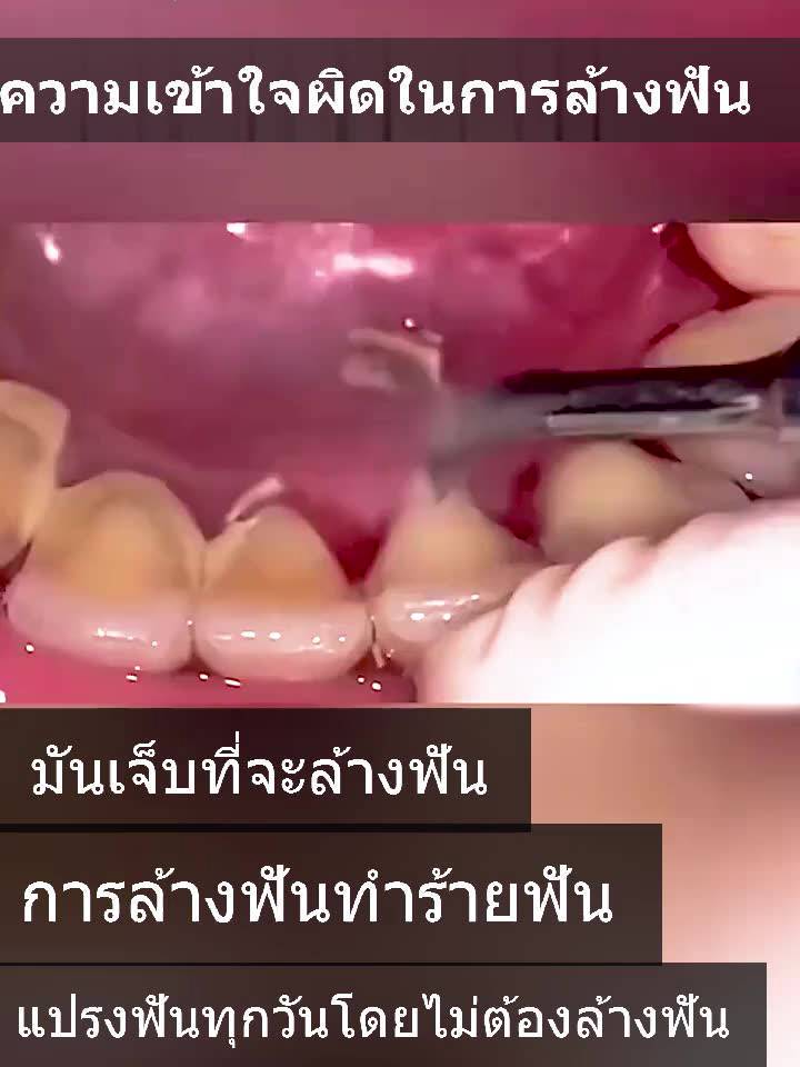 ซื้อมันดีกว่าไปล้างฟันที่รพประหยัดเงินกว่าsmile-athome-ทำความสะอาดฟัน-ความสะอาดฟันไฟฟ้า-เครื่องขัดหินปูน-เครื่องขัดฟัน