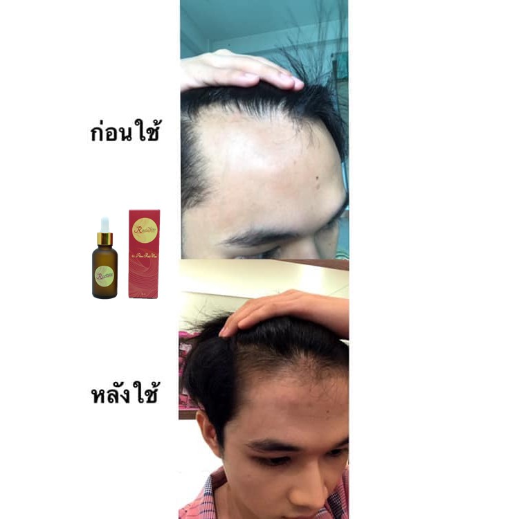 ภาพสินค้าเห็นผลจริง  เซรั่มปลูกผมRanee Hair Serum แบบลูกปัดและลูกกลิ้ง ขนาด 15 ml. เซรั่มปลูกผม ไรผม คิ้ว เครา หนวด จากร้าน haru.shop.97 บน Shopee ภาพที่ 5