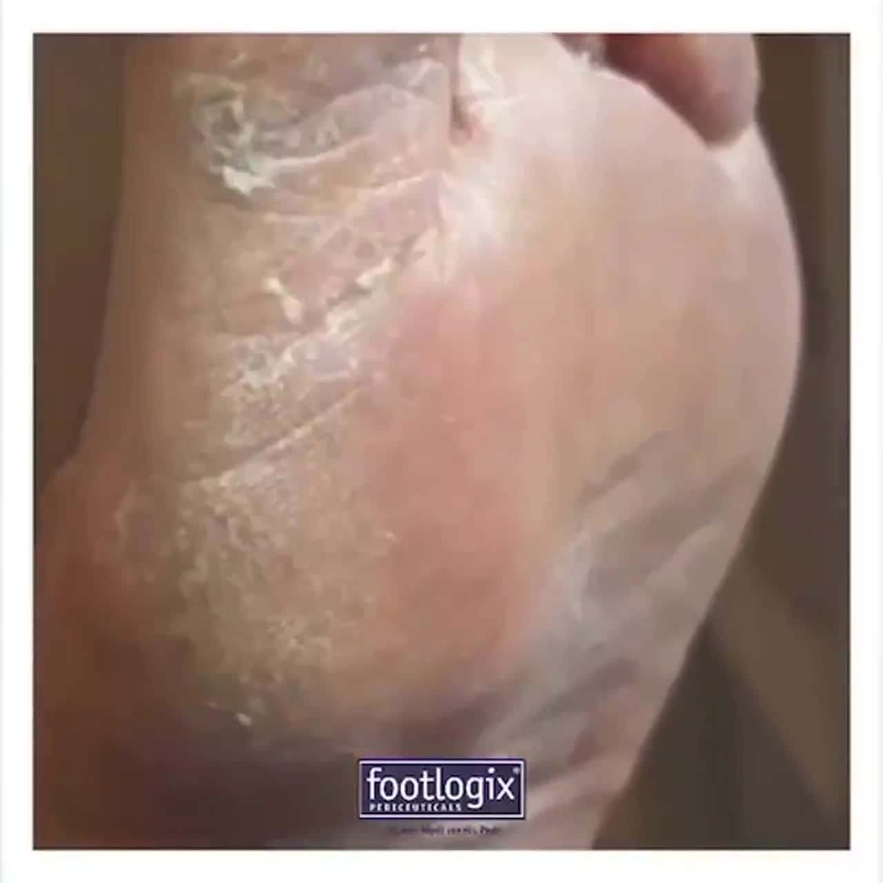 footlogix-callus-solftener-ฟุตโลจิกน้ำยาขัดส้นเท้าด้าน-น้ำยาตัดหนัง-ไม่มีส่วนผสมของกรดผิวแพ้ง่ายใช้ได้-ขัดเกลี้ยงเกลา