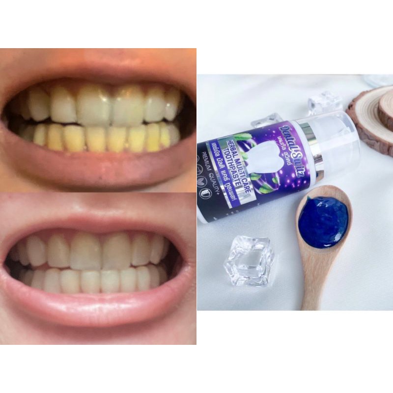 1แถม1เจลฟอกฟันขาว-dental-swizt-ฟอกฟันขาวง่ายๆได้ด้วยตัวเองที่บ้าน