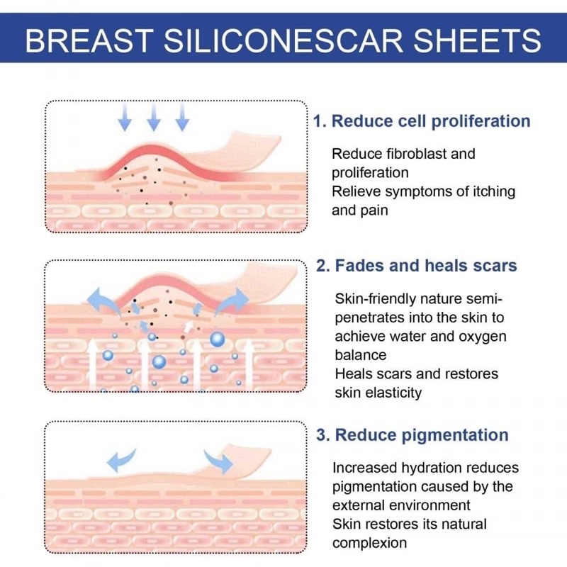 breast-silicone-scar-sheets-แผ่นแปะลบลอยแผลสมานรอยแผล