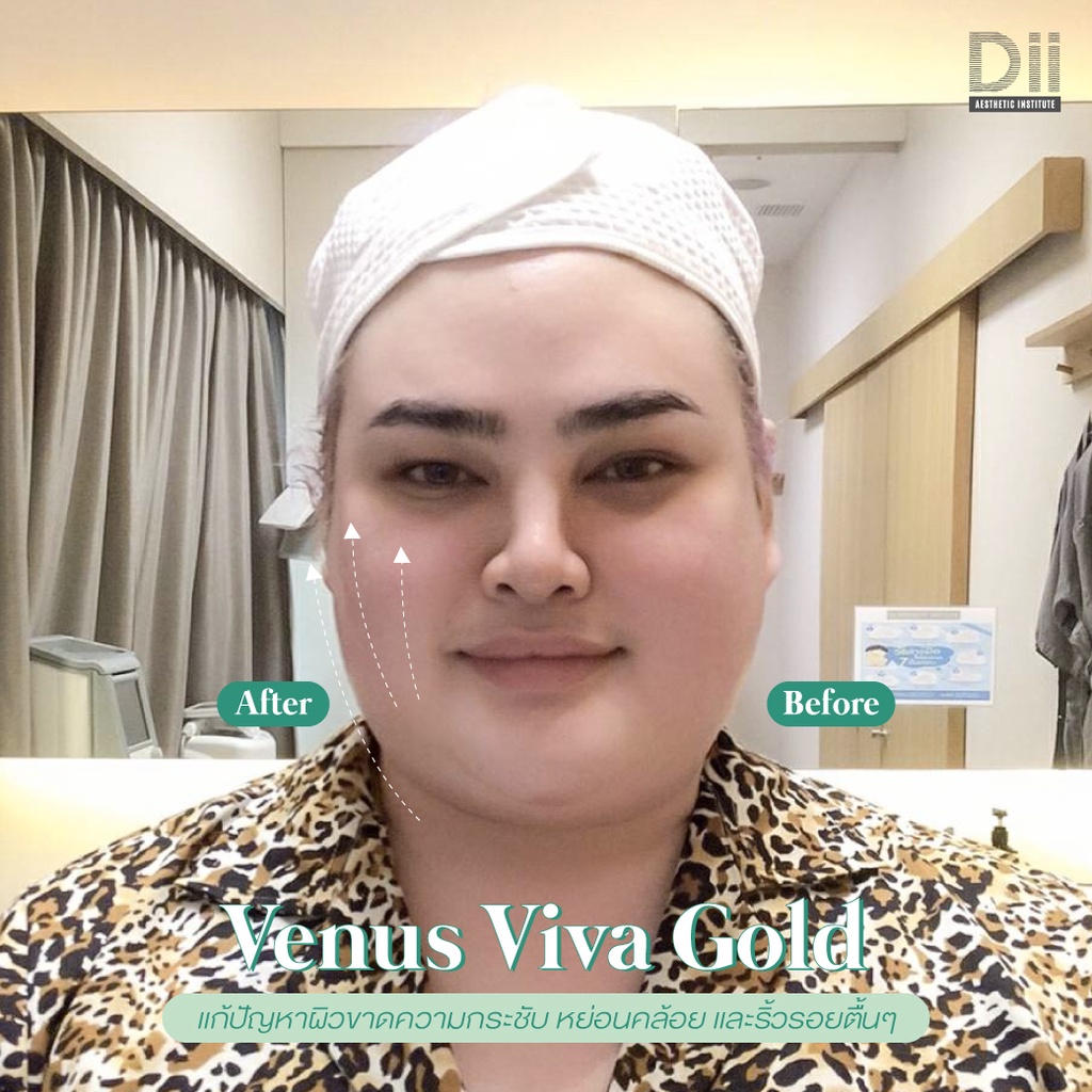 ภาพหน้าปกสินค้าDii Aesthetic : Venus viva Gold 1 Time จากร้าน dii_aesthetic บน Shopee