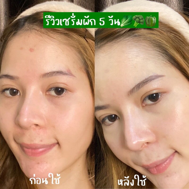 สั่งในไลฟ์ลด50-เซรั่มผัก-ลดสิว-ฟื้นฟูผิวแข็งแรง-yerpallthailand