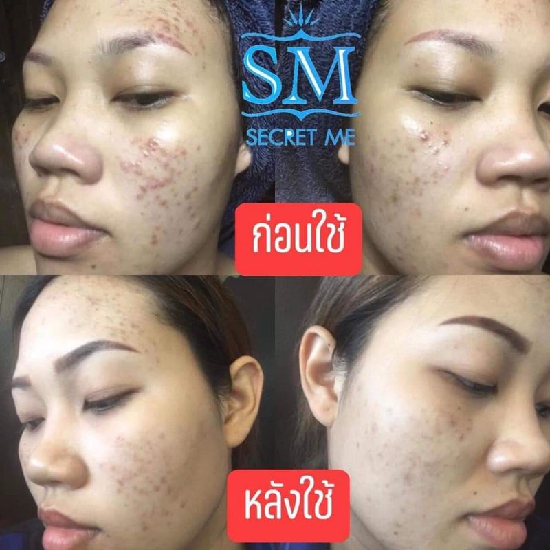 พร้อมส่ง-sm-skin-me-4ตัว-จบครบทุกปัญหาผิวหน้า