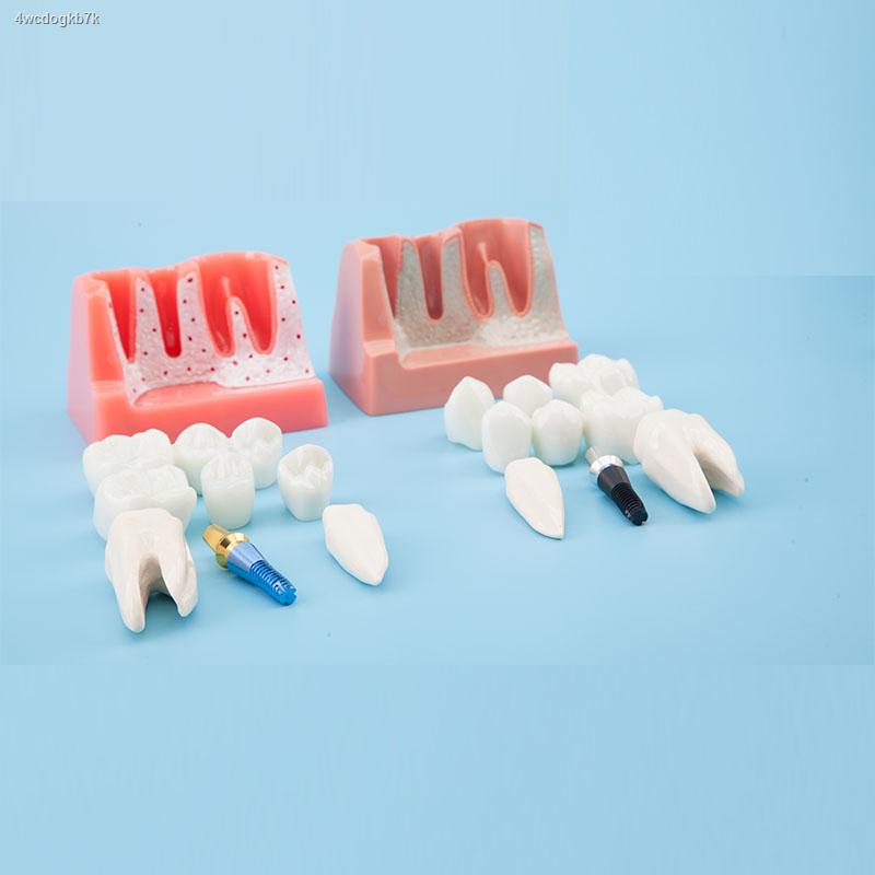 แบบจำลองรากฟันเทียม-การสอนฟันในช่องปาก-พยาธิวิทยา-แบบจำลองการสื่อสารระหว่างแพทย์และผู้ป่วย-สะพานฟัน-รากฟันเทียม