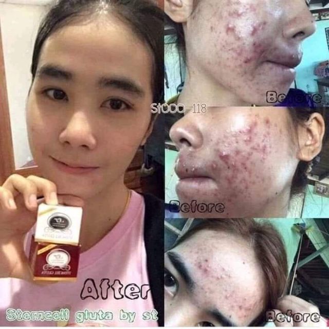 ครีมเสต็มเซลล์กลูต้า-stem-cell-gluta-by-st