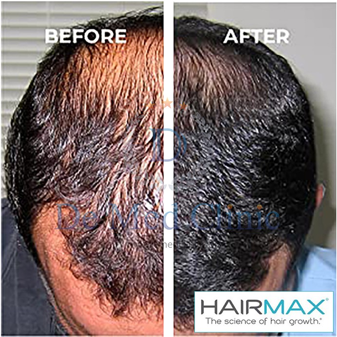 hairmax-laserband-82-แบบที่คาดผม-ราคาปกติ-55-000บาทพิเศษราคา49-500-บาทแถมพิเศษtriple-h-treatment-ดูแลผม-1ครั้ง