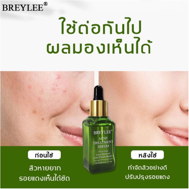 ของแท้-breylee-เซรั่มลดสิว-ครีมลดสิว-ครีมแต้มสิว-เจลแต้มสิว-เจลรักษาสิว-ครีมกำจัดสิว-ครีมรักษาสิว-ครีมสลายสิว-กำจัดสีว