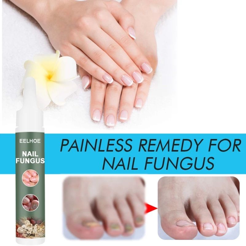 nail-fungus20ml-วิธีแก้ปัญหาการรักษาเชื้อราเล็บ-มือและเล็บเท้าที่แข็ง