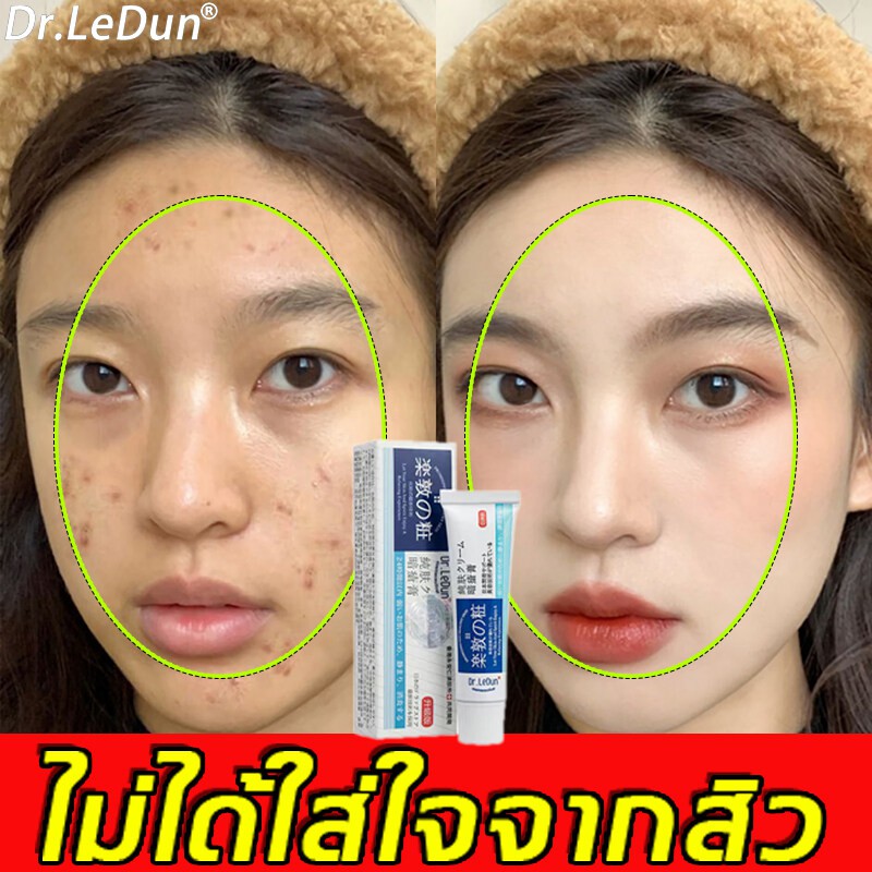 dr-ledun-ครีมลดสิว-20g-ครีมแก้ฝ้า-สิวหายถาวร-ครีมแต้มสิว-เจลรักษาสิว-เจลแต้มสิว-ครีมกำจัดสิว-ครีมบำรุงหน้า-ครีมหน้าขาวใส