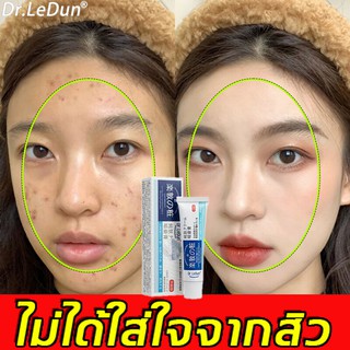 Dr.LeDun ครีมลดสิว 20g ครีมแก้ฝ้า สิวหายถาวร ครีมแต้มสิว เจลรักษาสิว เจลแต้มสิว ครีมกำจัดสิว ครีมบำรุงหน้า ครีมหน้าขาวใส