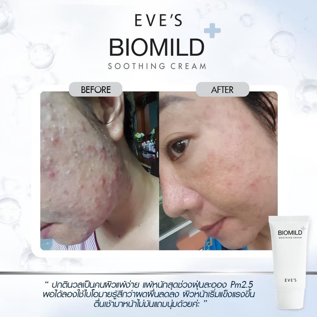 biomild-แก้ปัญหาผิวติดสาร-แพ้ง่าย-สิวเห่อ